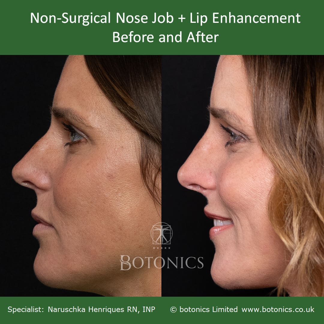 Left profile of patient before non-surgical nose job and after treatment with dermal filler