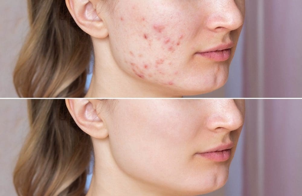 How Does Roaccutane Work?