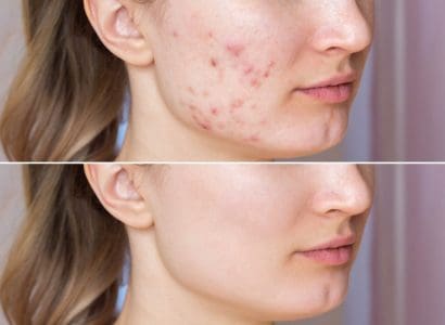 How Does Roaccutane Work?