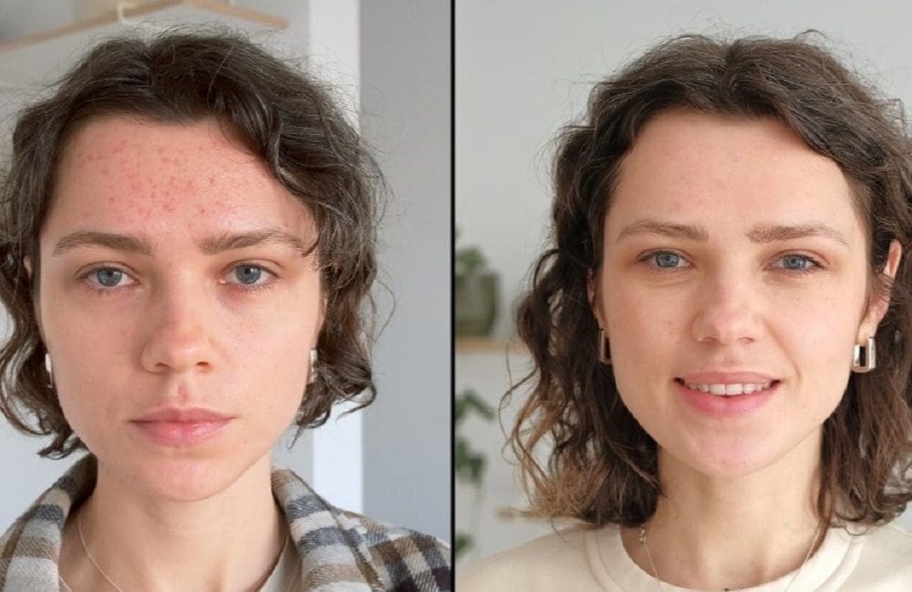 How Long Does Roaccutane Take To Work?