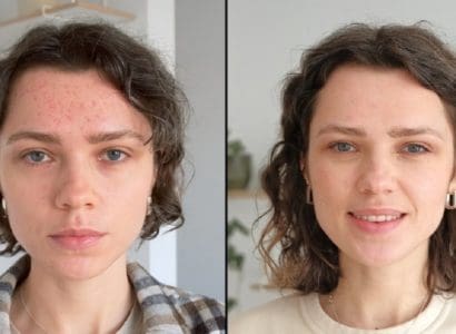 How Long Does Roaccutane Take To Work?