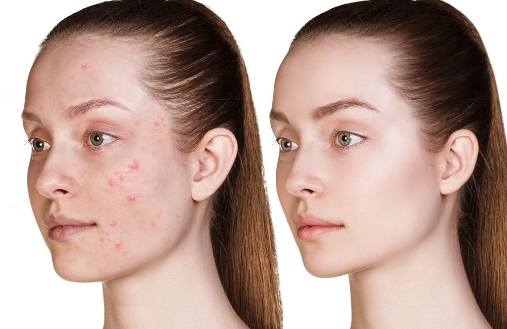 Is Roaccutane Treatment Right For Me?