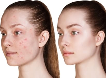 Is Roaccutane Treatment Right For Me?