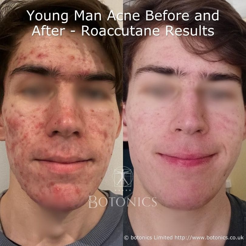 Accutane Before And After Cystic Acne